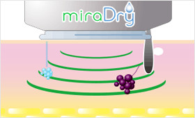 ミラドライの仕組み02 マイクロウェーブの照射