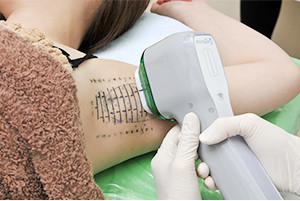 ミラドライの再発を防ぐために